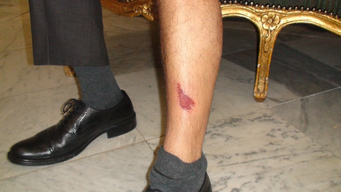 aly_weslaty_blessure